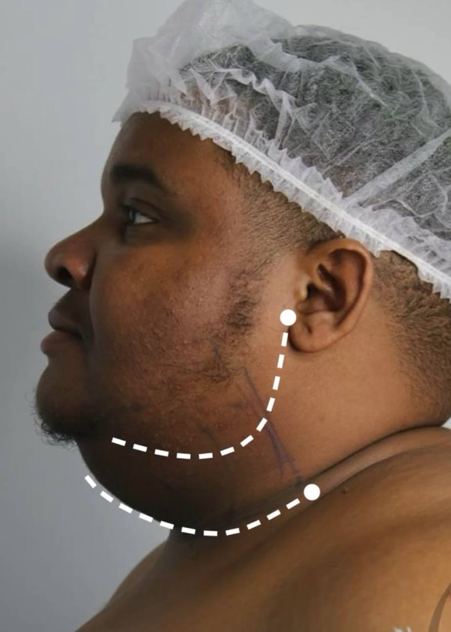 before procedure