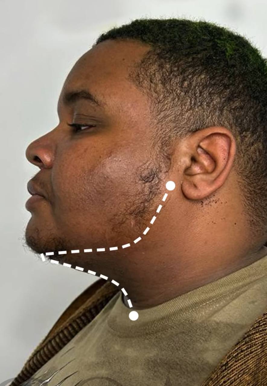 after procedure