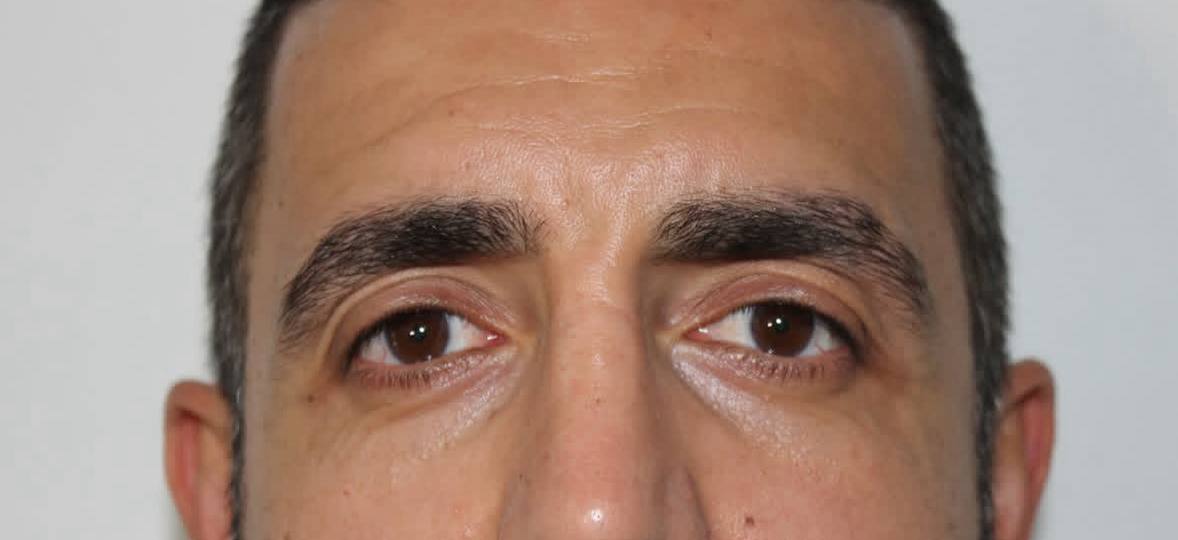 before procedure
