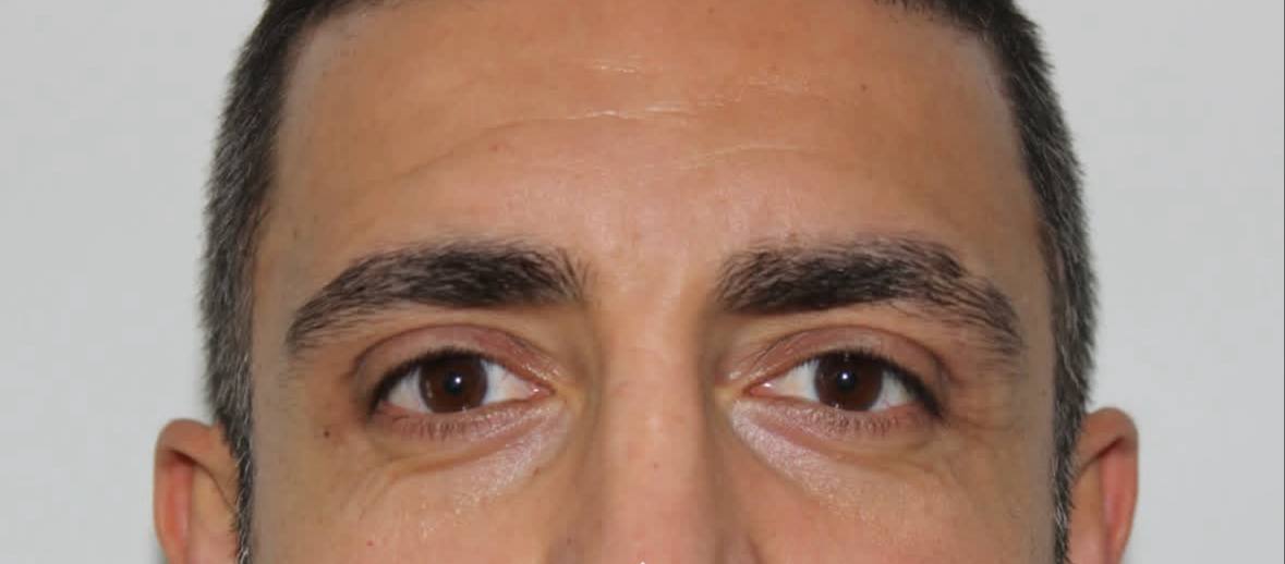 after procedure