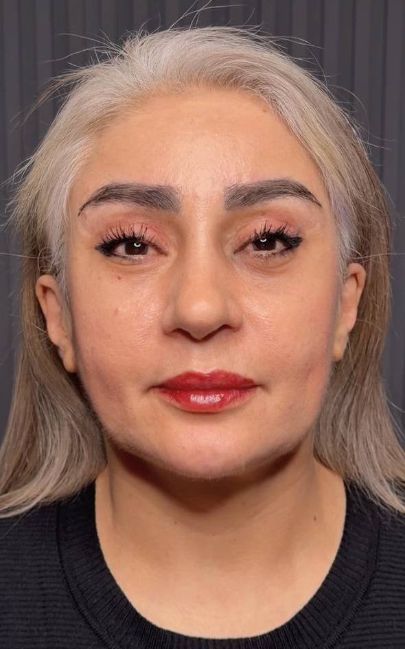after procedure