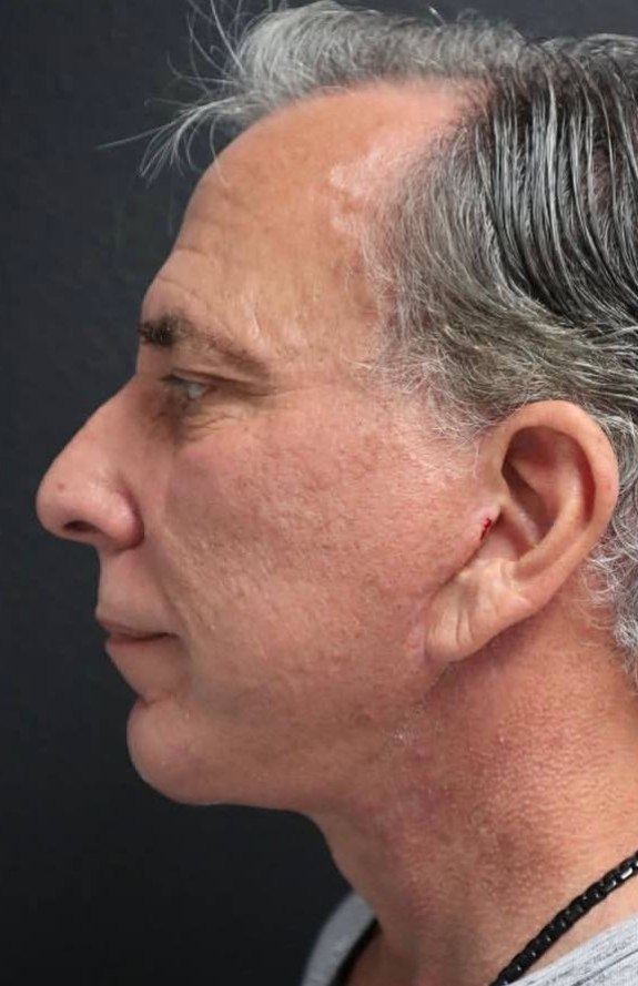 after procedure