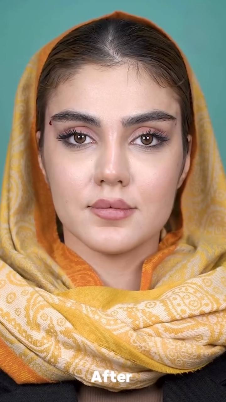 after procedure