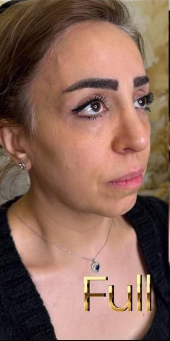 before procedure