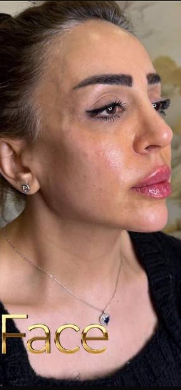 after procedure
