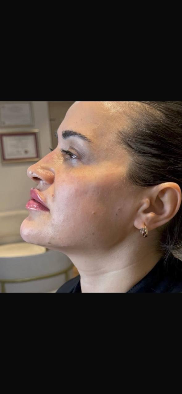 after procedure