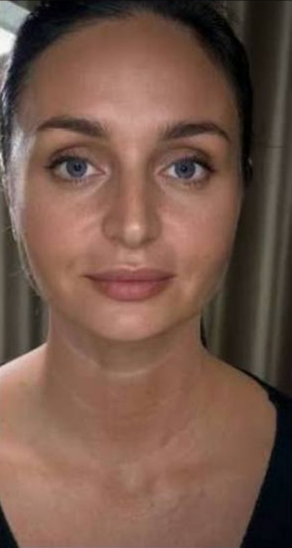 after procedure