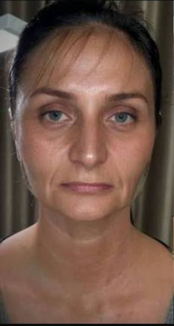 before procedure
