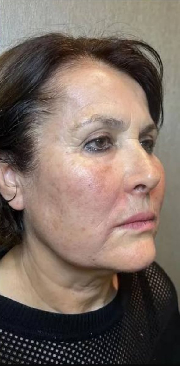after procedure