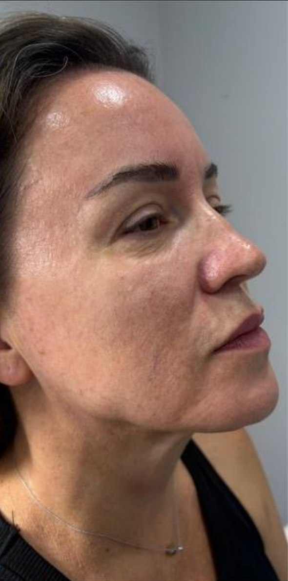 before procedure