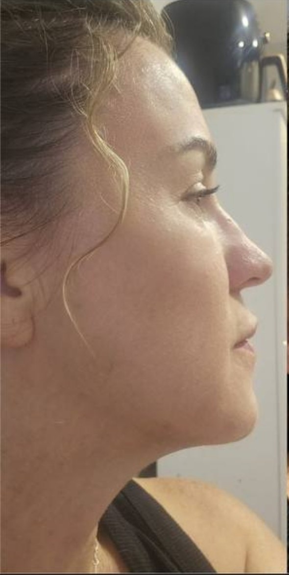 after procedure